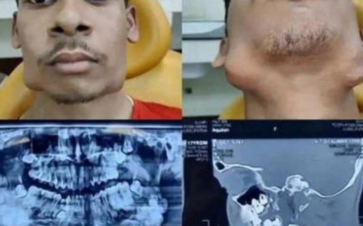Imaging examination revealed additional teeth