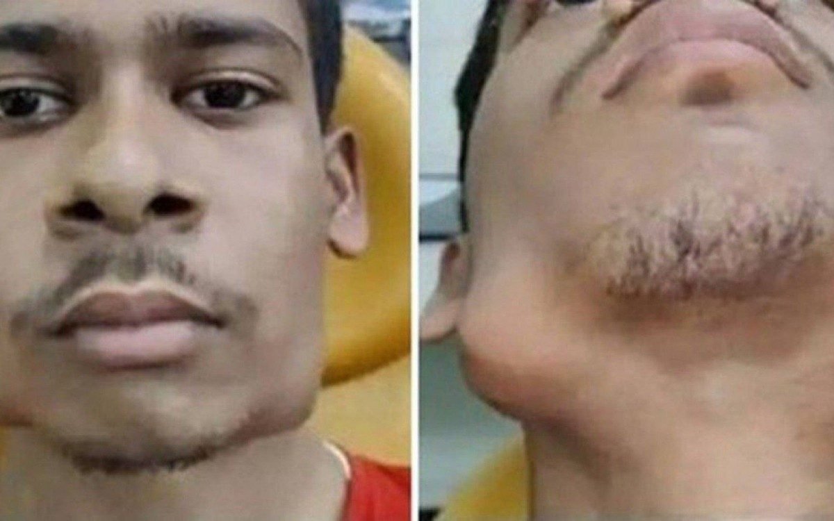 17 year old youth had to undergo surgery to remove the tooth