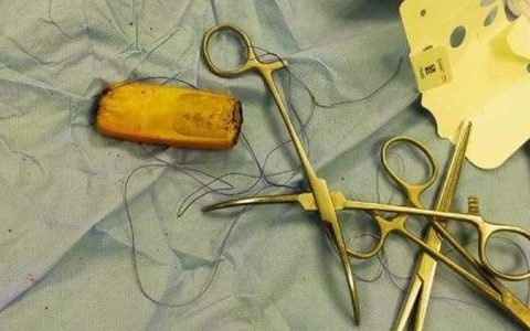 Man swallows cell phone, waits 6 months for nature to work, but is operated on