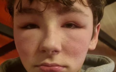 Teenager has 'allergic reaction' after using virtual reality glasses
