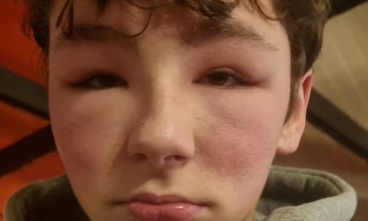 Teenager has 'allergic reaction' after using virtual reality glasses